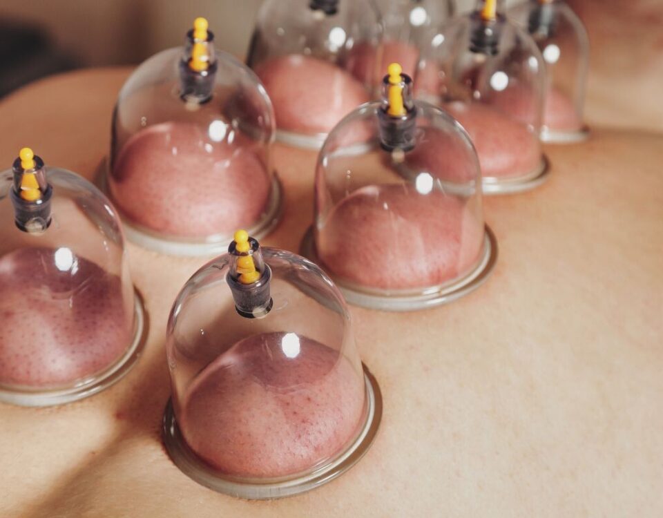 Cupping Therapy